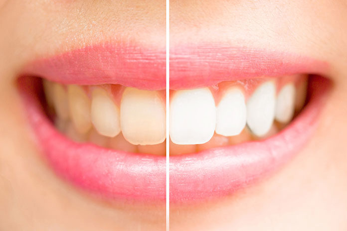 Wybielanie zębów – co to
