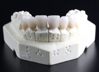 5 mitów na temat implantów zębowych