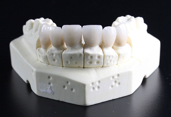 5 mitów na temat implantów zębowych